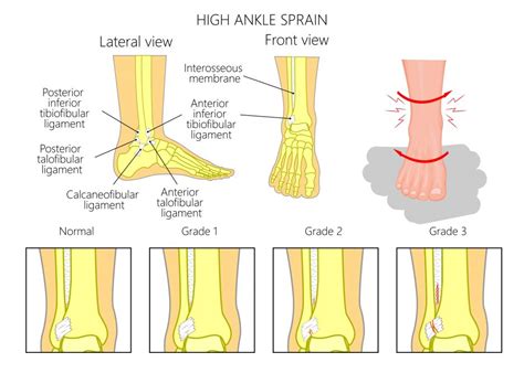 sprained ankle deutsch|More.